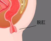 合肥治療脫肛 合肥肛腸醫院 合肥肛門醫院哪家好