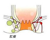 合肥治療肛瘺 合肥肛腸醫院 合肥肛門醫院哪家好