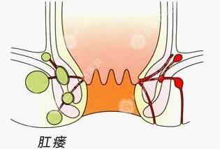 肛瘺疾病 肛瘺常識